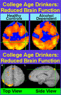 before and after alcohol brain